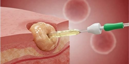 SERVIÇOS 9 Drenagem de abscessos