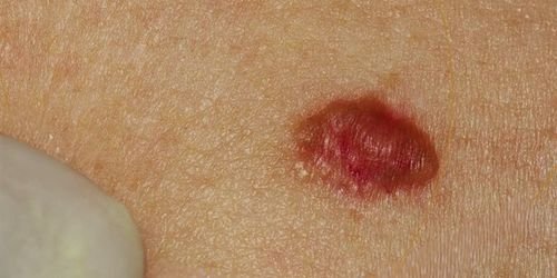 SERVIÇOS 5 Cancer de pele