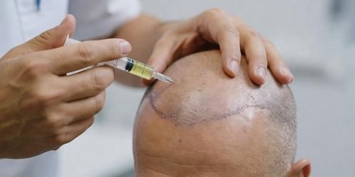 SERVIÇOS 12 Transplante capilar de células-tronco