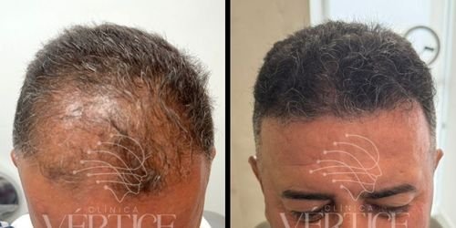SERVIÇOS 11 Transplante capilar
